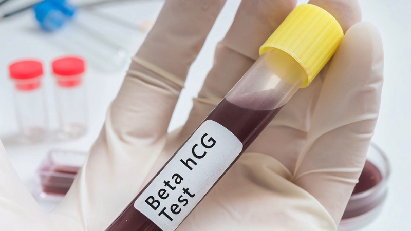 Laboratorijski tehničar drži epruvetu sa uzorkom krvi za beta hCG test