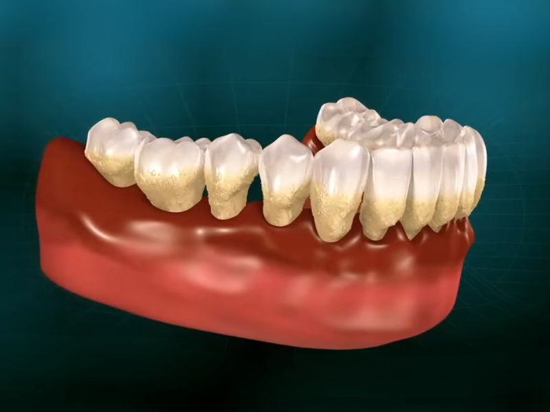 prikaz Parodontopatije