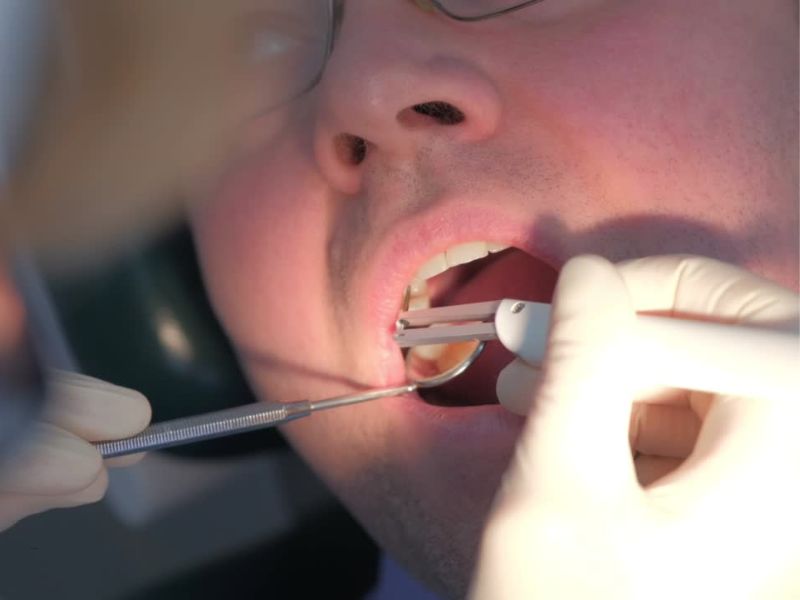 profesionalno čišćenje zuba