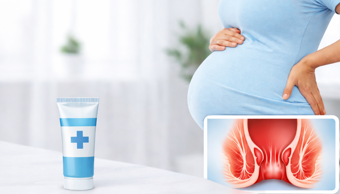 Najbolji gel za hemoroide u trudnoći